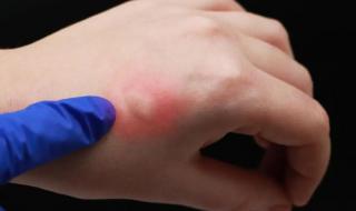 为什么我特别招蚊子 为什么有些人招蚊子